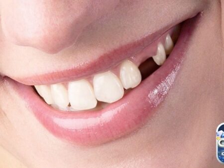Mơ gãy răng báo điềm gì: Giải mã tổng quát mơ thấy gãy răng